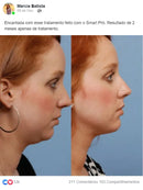 Led Facial Smart Pro - Resultados Garantidos